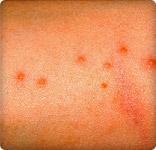 Red bed bug bites on skin.